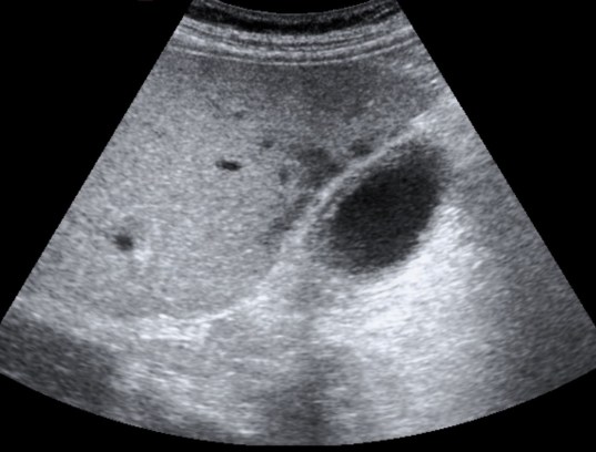Áreas hipoatenuadas mal definidas compatibles con con afectación del parénquima hepático adyacente.