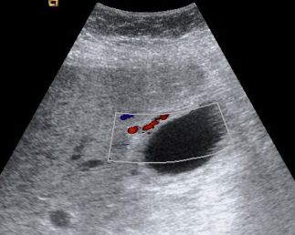Signos de hiperemia mural.