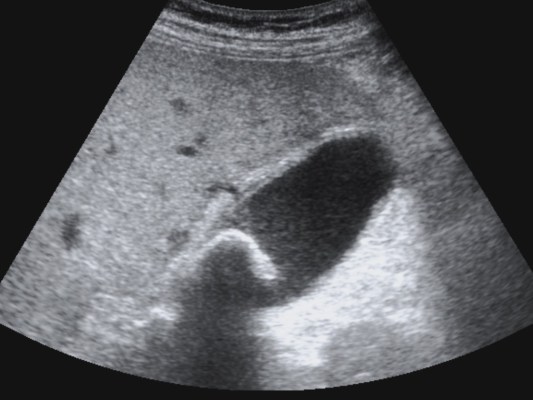 Colecistitis aguda con imagen de disrupción mural de 4 mm aprox.