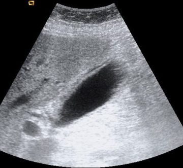 Vesicula alitiasica distendida con engrosamiento y halo hipoecogénico mural.