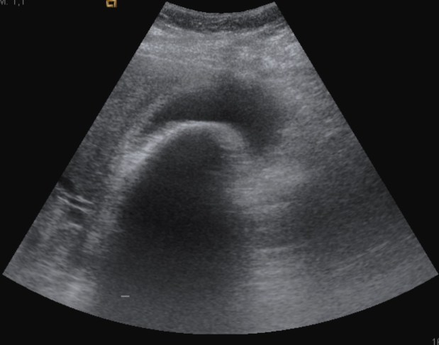 Persiste el engrosamiento de pared vesicular.