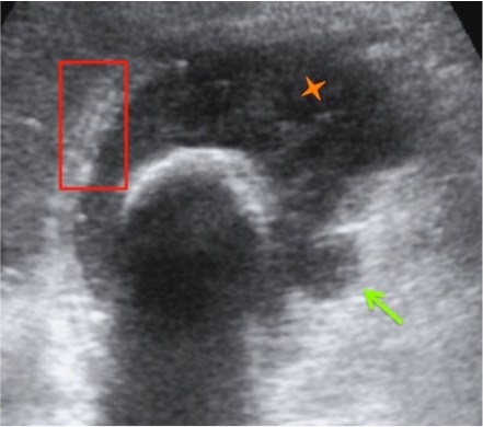 Engrosamiento mural con banda hipoecogénica en pared (rectángulo rojo). Colección mural (flecha verde). Contenido biliar de ecogenicidad heterogénea (estrella naranaja).