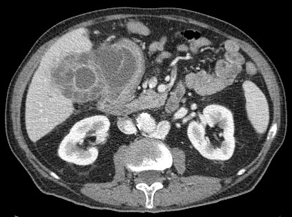 Colecistitis Xantunogranulomatosa con fístula duodenal.