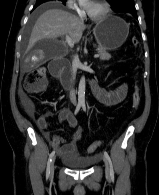 Reconstrucción coronal.