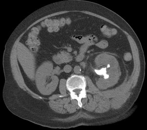 En esta imagen vemos claramente que se trata de una litiasis coraliforme. Observar el engrosameinto de la fascia perirrenal anterior y psterior en comparación con el riñón conralateral.