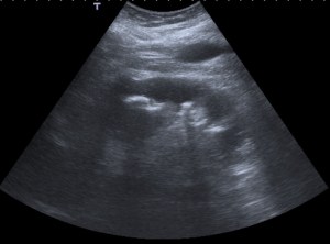 Se observa el riñón izqueirdo de mayor tamaño que el contralateral. La ecoestructura es heterogénea y mal definida. En este corte observamos además imágenes hiperecogéncicas compatibles con litiasis.