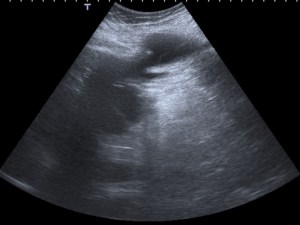 La colección es considerable y parece extenderse desde la región postero-superior del riñón hacia partes blandas.