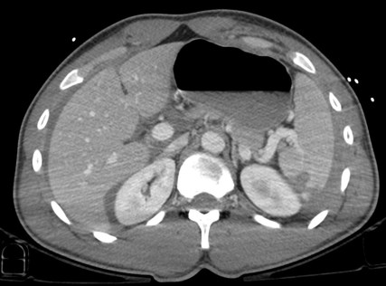 Se observa el hilio respetado