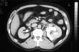 Paciente con litiasis ureteral que provocó rotura de la vía excretora. En el TAC con contraste se demuestra la extravasación de éste al EPR. Fuente: Dr. Eugenio L. Navarro Sanchís.