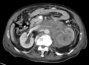 Linfoma renal y perirrenal izquierdo.