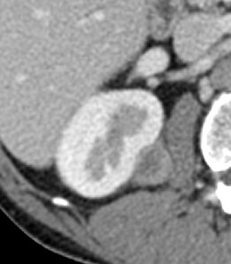 Lesión nodular heterogénea en el espacio perirrenal derecho correspondiente a metástasis de un carcinoma de pulmón