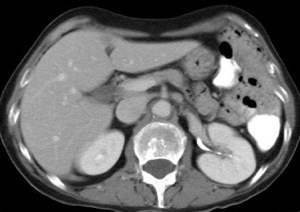 Banda diafragmática que cruza el espacio perirrenal derecho.