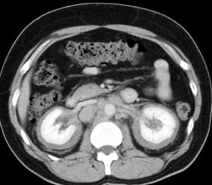 Fibrosis retroperitoneal con especial distribución perirrenal. 