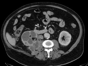 Absceso perirrenal derecho secundario a pionefrosis. Se ve una colección líquida con pared que realza con el contraste. Hay cambios inflamatorios en la grasa que lo rodea. Fuente: Dr. Eugenio L. Navarro Sanchis.