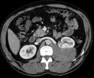 Linfoma perirrenal izquierdo que desplaza anteriormente el riñón.