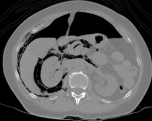 neumoperitoneo y la presencia de gas en los espacios pararrenal anterior, pararrenal posterior (lateral y posterior al hígado), perirrenal derecho e izquierdo (que se demuestran comunicados), así como enfisema entre los músculos intercostales derechos.