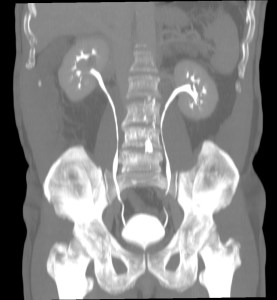 En fase excretora no se observo afectación de las vías urinarias ni cambio de realce signficativo en la masa.