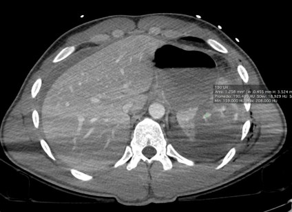ROI: 190 UH.  Equivalente con sangrado activo.