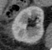 Líquido "sudor" perirrenal.