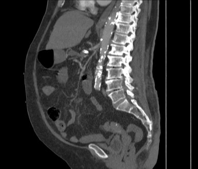 AMS superior muy filiforme, no permeable en su ostium de salida y repermeabilizada posteriormente por colaterales.
