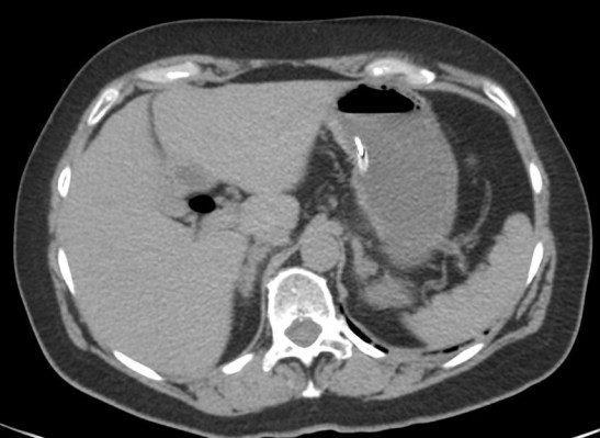 Se observa neumobilia en el arbol biliar.