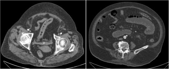 Mismo paciente. Dilatación de asas de yeyuno y engrosamiento mural de íleon compatible con isquemia intestinal por bajo gasto. Recordar que la AMS irriga desde la 2ª porción duodenal hasta el colon en la flexura esplénica.