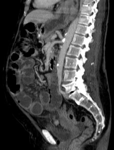 Gran ateromatosis calcificada que afecta el ostium de salida del tronco celiaco y la AMS.