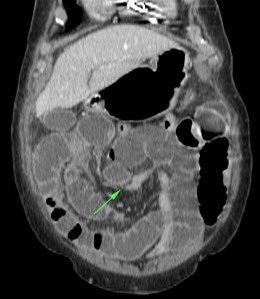 Brida en yeyuno con cambio de calibre y distensión retrógada de asas, cuya pared sufrió una isqumia intestinal debido al comprismo vascular del cuadro obstructivo.