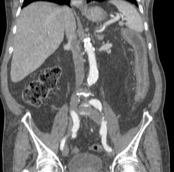 Segmento de colon izquierdo afectado por colitis isquémica probablemente por bajo gasto.