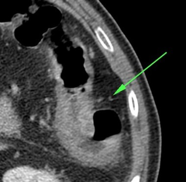 Engrosamiento mural y aumento de realce en paciente con colitis isquémica
