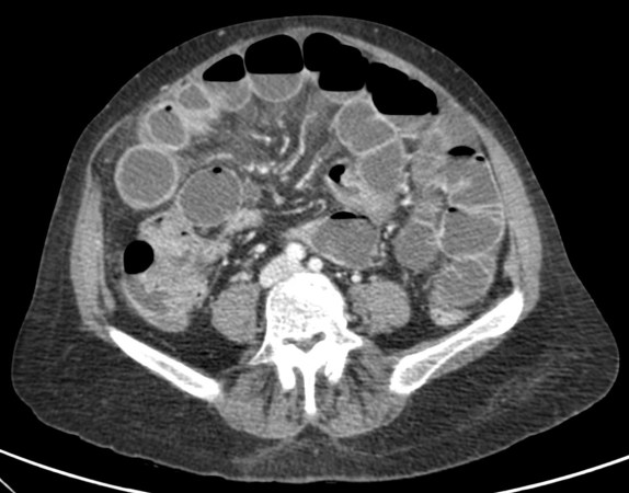 Existe ademas infiltración de la grasa mesentérica y congestión de vasos.