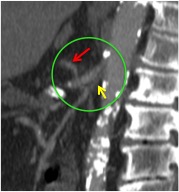 Flecha amarilla: AMS filiforme no permeable en su ostium de salida. Flecha roja: colateral que repermeabiliza la AMS.