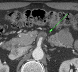 Trombo en sector proximal de la AMS.