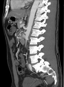 Mismo paciente. Se observa una trombosis que produce una estenosis muy significativa de la AMS con desarrollo de colaterales que permiten mantener la vascularización. El pacient no presentaba signos de sufrimiento de asas.