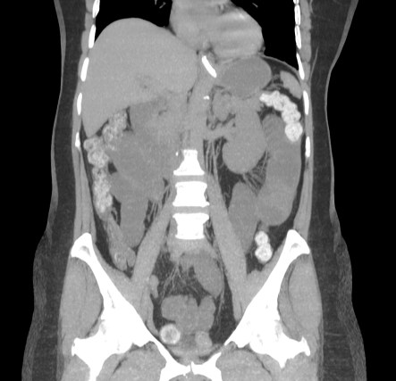 Recontrucción coronal con MIP. Se observa la litiasis enclavada en el íleon terminal.  Observar como posterior a la litiasis hay un cambio de calibre,  el segmento que queda de ileon y el colon  no están distendidos.
