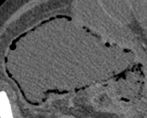 Corte axial donde se observa el ciego distendido con "paper thin wall" y neumatosis.