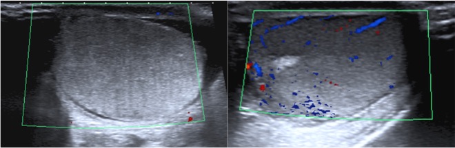 Ausencia de capatación de flujo Doppler color en testículo derecho.