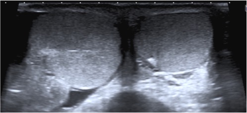 Asimetría de tamaño. Corte axial. Observar el notable aumento de tamaño del testículo derecho.