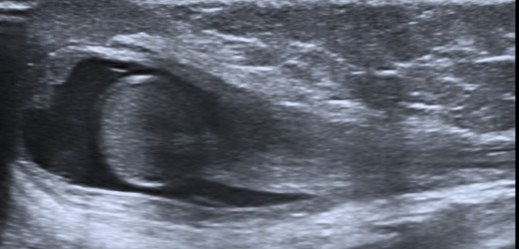 Se observa el testículo y el cordón espermático. Nótese el marcado engrosamiento de cubiertas, el hidrocele y engrsoamiento del cordón.