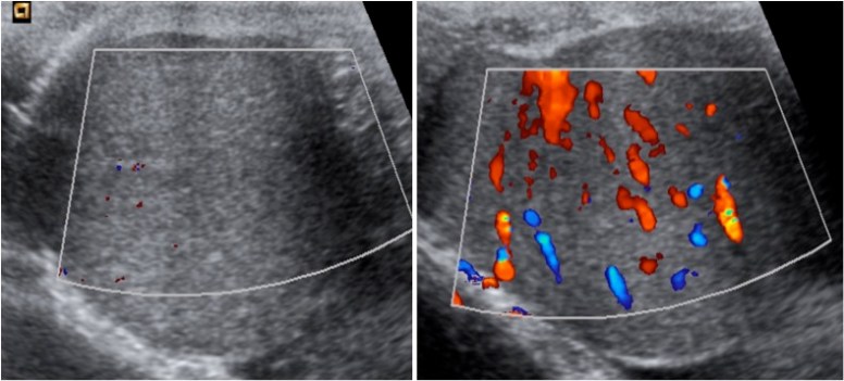 A la izquierda se observa ausencia de captación de señal Doppler color. A la derecha, se observa el testículo hiperémico tras detorsión manual.