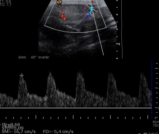 Flujo sanguíneo de características normales. IR 0,67 (Normal).