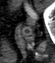 Uréter dilatado con realce mural, hallazgos compatibles con ureteritis.