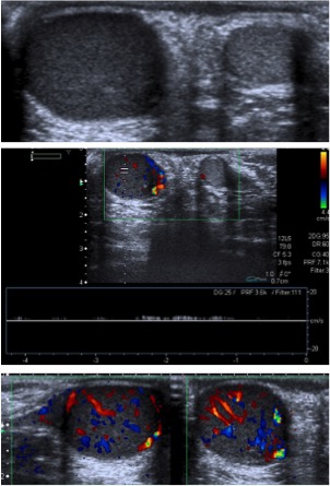 Teste derecho muy aumentado de tamaño, hipoecogénico de forma difusa y con muy alta captación de señal Doppler color. El diagnóstico final fue infiltración difusa testicular por leucemia.