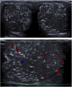 Microlitiasis intraparenquimatosas.