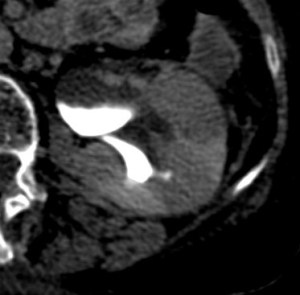 Nefrograma persistente.