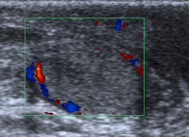 Orquiepididmitis con zonas intraparenquimatosas de aspecto hipoecogénico.