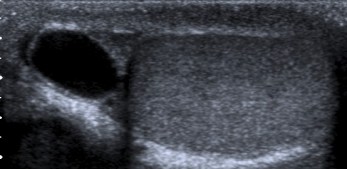 Quiste en la cabeza del epidídimo.