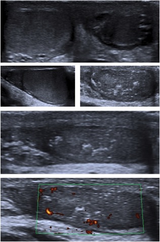 Se observa un paciente intervenido de orquidopexia bilateral post torsión testicular DCHA. El teste derecho es asimétrico, más pequeño que el contralateal, de ecogenicidad heterogénea, con foco de alta ecogenicidad en relación con cambios crónicos. A pesar de la torsión, conserva captación de señal Power Doppler.