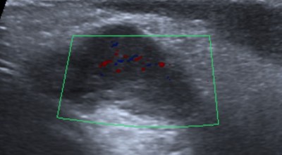 Testículo mal definido e irregular con zonas que no muestras captación de Doppler color.