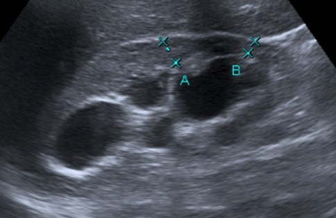 Se observa ectasia del sistema pielocalicila con disminución del grosor cortical. Hidronefrosis severa grado IV.